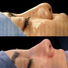 نتائج عملية تجميل الأنف قبل وبعد، تحسين شكل ومظهر الأنف