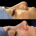 نتائج عملية تجميل الأنف قبل وبعد، تحسين شكل ومظهر الأنف