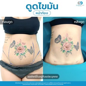 before-after photo vaser-liposuction