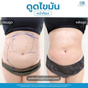 before-after photo vaser-liposuction