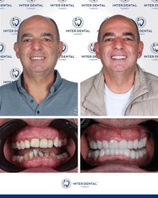 before-after photo implantacia-zuba