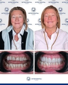 before-after photo implantacia-zuba