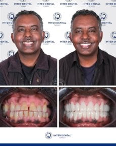 before-after photo implantacia-zuba