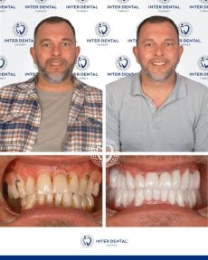 before-after photo implantacia-zuba