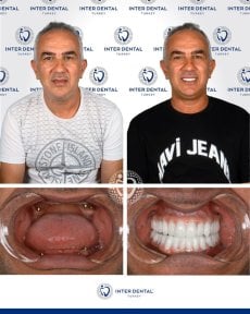 before-after photo implantacia-zuba