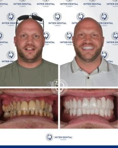 before-after photo implantacia-zuba