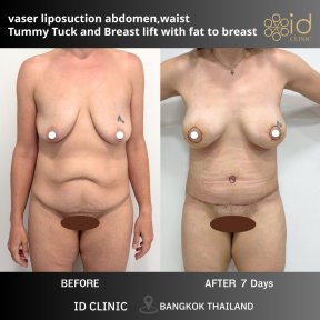 before-after photo mastopexy-breast-lift-contour-plastics