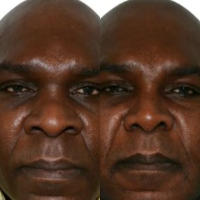 before-after photo korrekciya-shirokogo-nosa
