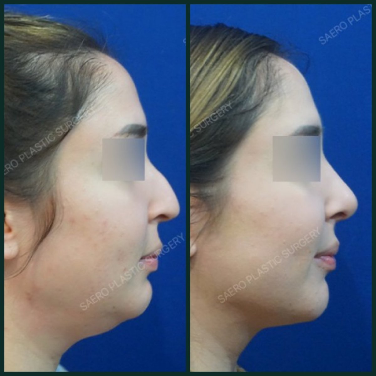 نتائج شد الرقبة قبل وبعد في SAERO Plastic Surgery – تحديد أوضح للفك