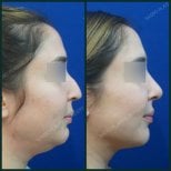 Before and after neck lift results at SAERO Plastic Surgery – improved jawline definition