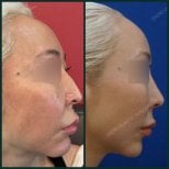 Результати підтяжки нитками до і після в SAERO Plastic Surgery – покращення контуру обличчя