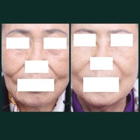 Результати до і після ниткового ліфтингу в SAERO Plastic Surgery, підтяжка шкіри обличчя