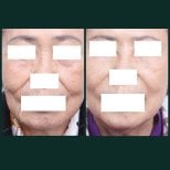 Результати до і після ниткового ліфтингу в SAERO Plastic Surgery, підтяжка шкіри обличчя