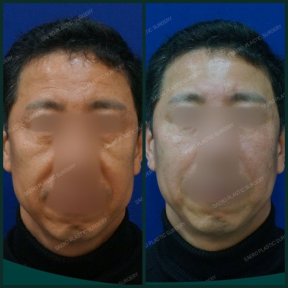 Результаты до и после нитевого лифтинга в SAERO Plastic Surgery, подтяжка кожи лица