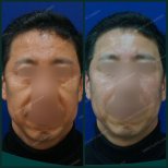 Результаты до и после нитевого лифтинга в SAERO Plastic Surgery, подтяжка кожи лица