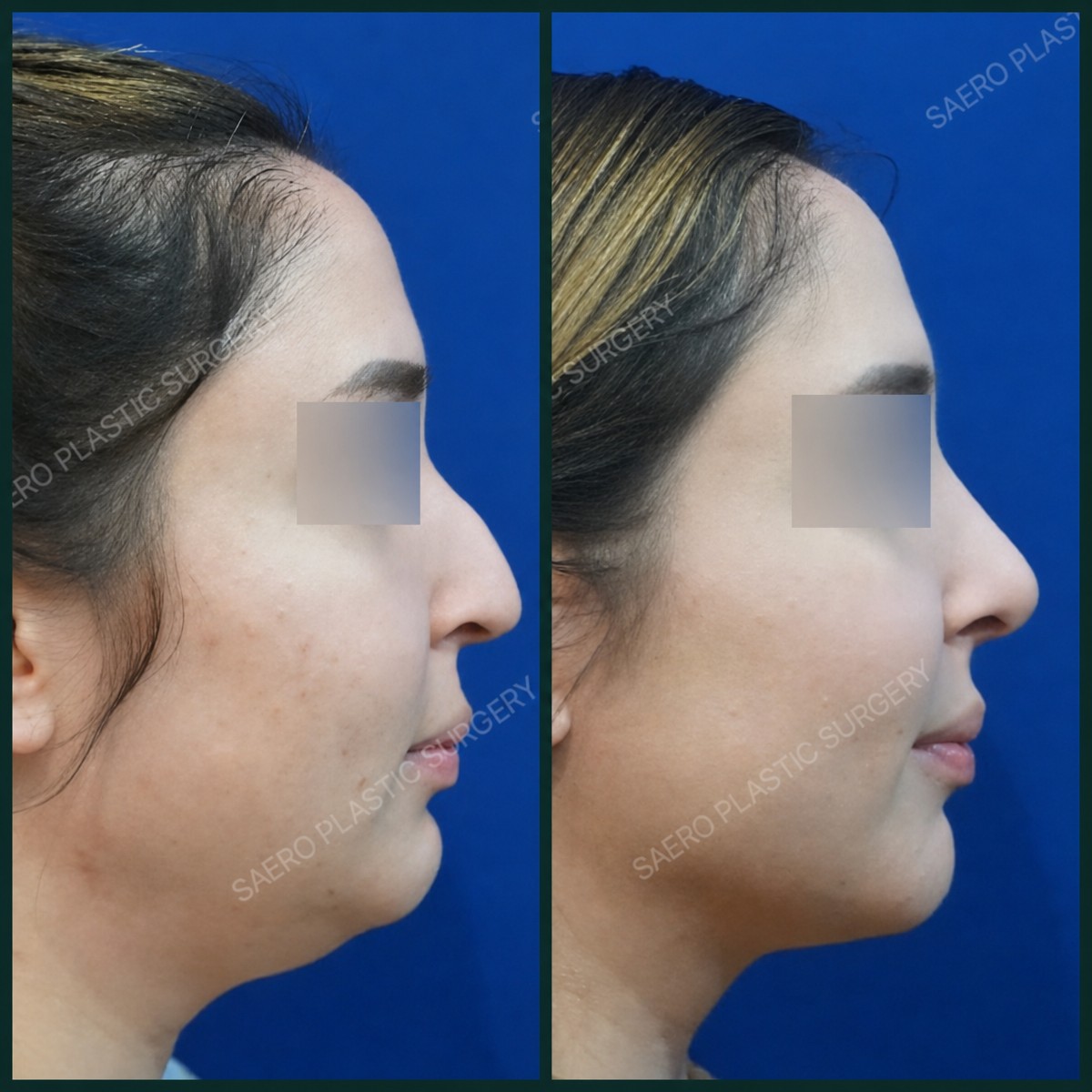 نتائج شد الوجه بالخيوط في SAERO Plastic Surgery – تحسين خط الفك والرقبة