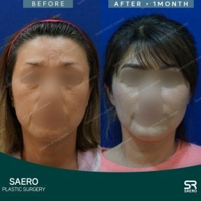Результати ниткового ліфтингу до і після в SAERO Plastic Surgery, покращення контуру обличчя
