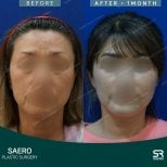 Результати ниткового ліфтингу до і після в SAERO Plastic Surgery, покращення контуру обличчя