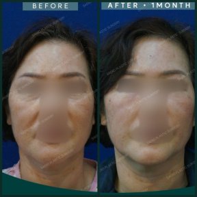 Результаты подтяжки нитями до и после в SAERO Plastic Surgery, видимое омоложение лица