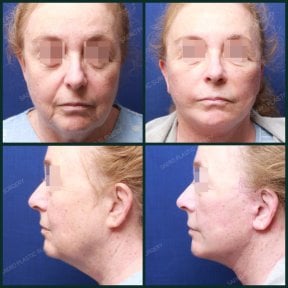 Результати до і після ниткового ліфтингу в SAERO Plastic Surgery, омолодження обличчя