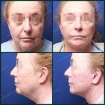 Результати до і після ниткового ліфтингу в SAERO Plastic Surgery, омолодження обличчя