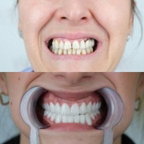 before-after photo zirconia-dental-bridge