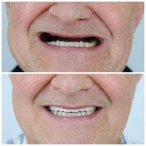 before-after photo zirconia-dental-bridge