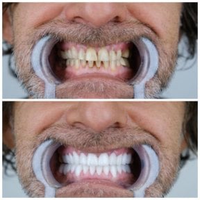 before-after photo zirconia-dental-bridge
