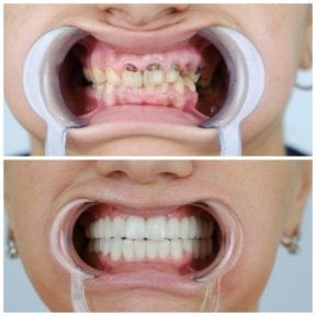 before-after photo zirconia-dental-bridge