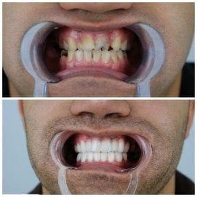 before-after photo zirconia-dental-bridge