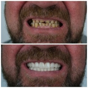 before-after photo zirconia-dental-bridge