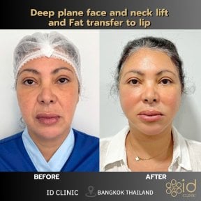 before-after photo facial-fat-transfer
