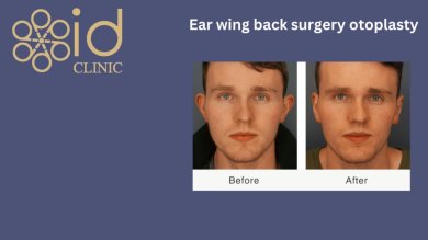 before-after photo hair-transplant