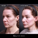Before and after deep plane facelift result at VG Plastic Surgery, visible facial rejuvenation