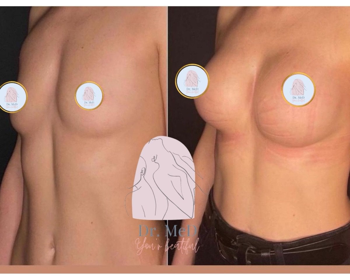 قبل وبعد تكبير الثدي في Dr. MED – نتيجة زيادة حجم وتناسق الثدي