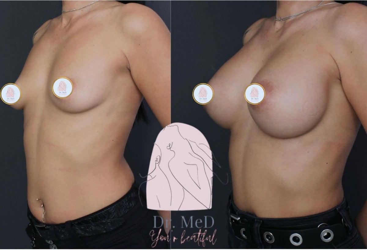 نتيجة تكبير الثدي قبل وبعد في عيادة Dr. MED – زيادة حجم وشكل الثدي