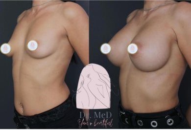 before-after photo breast-augmentation