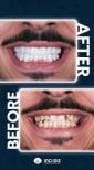Résultats avant et après implants dentaires chez Inci Dis International – sourire amélioré