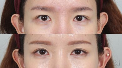 before-after photo brow-lift