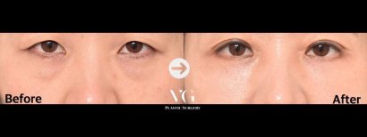 Before and after blepharoplasty results at VG Plastic Surgery, eyelid lift with rejuvenated look