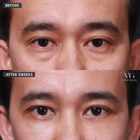 Before and after lower blepharoplasty at VG Plastic Surgery, visible eye bag removal result