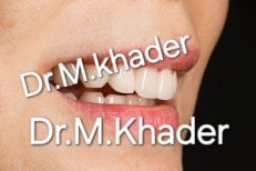 نتيجة الفينير في مستشفى ووهان ييا سيمي لطب الأسنان – ابتسامة محسنة وأسنان أكثر بياضًا