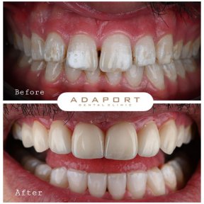 Résultat avant/après facettes Emax à Adaport Dental Clinic, transformation du sourire
