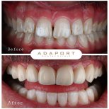 Résultat avant/après facettes Emax à Adaport Dental Clinic, transformation du sourire