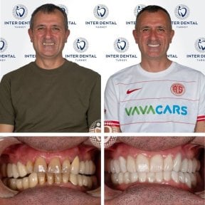 Before and after Hollywood Smile results at Inter Dental Turkey – visible smile transformation