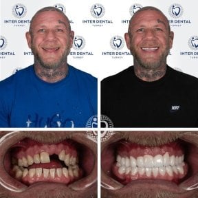 Hollywood Smile before and after results at Inter Dental Turkey – full smile makeover transformation