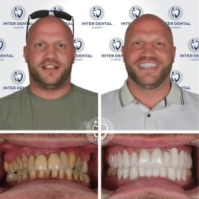 Hollywood Smile before and after results at Inter Dental Turkey – complete smile transformation