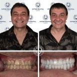 Before and after Hollywood Smile veneers at Inter Dental Turkey – dramatic smile transformation result