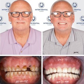 before-after photo zirconia-crown-installation