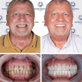 before-after photo zirconia-crown-installation